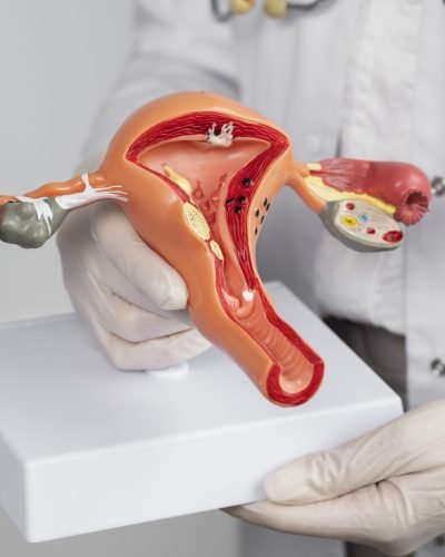 PCOS treatment By Dr. Nehi